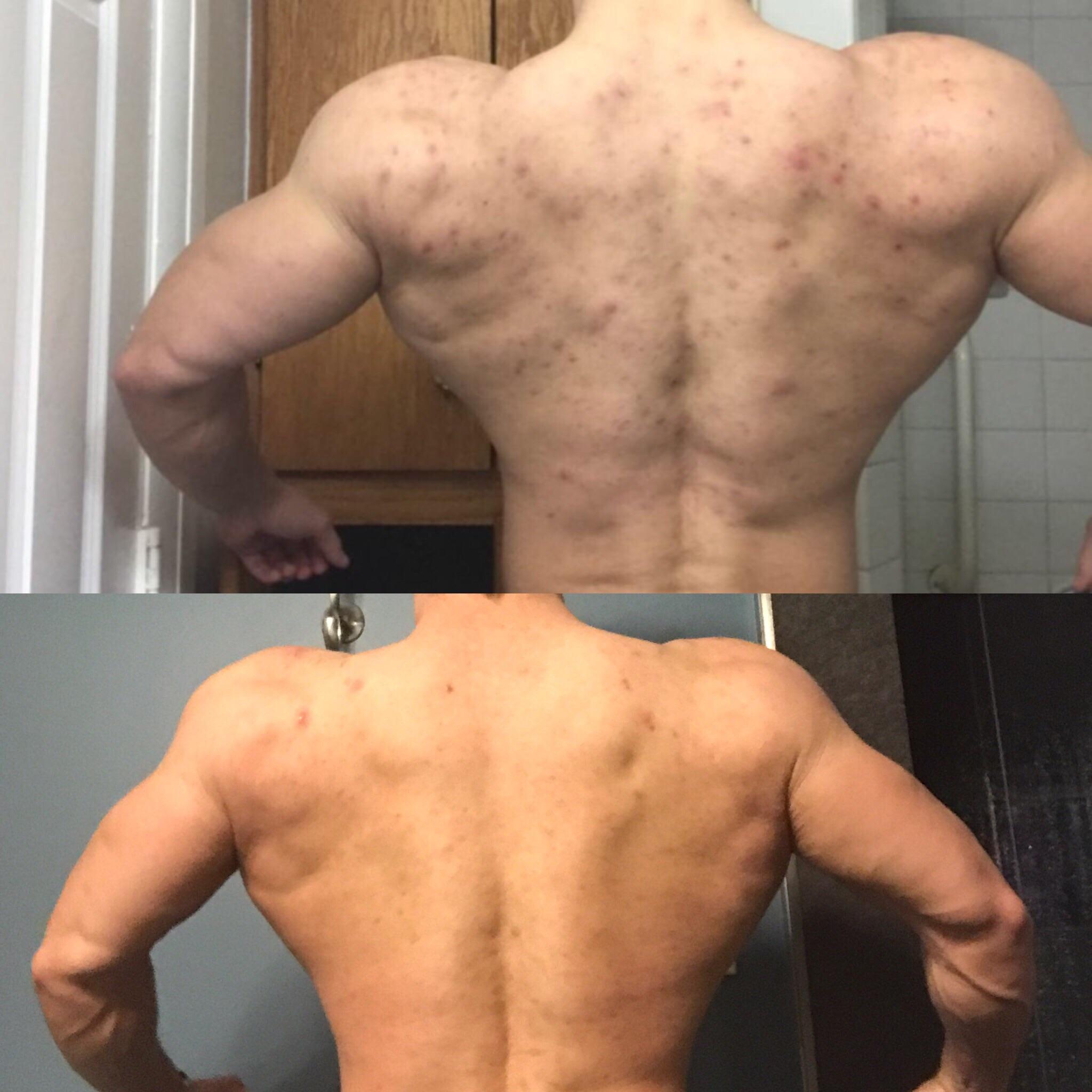 Accutane and Bodybuilding Reddit: Community Experiences Shared
